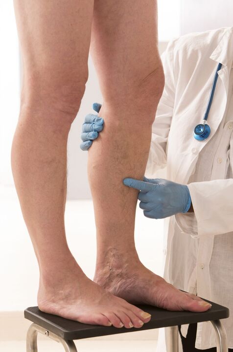 What varicosis is