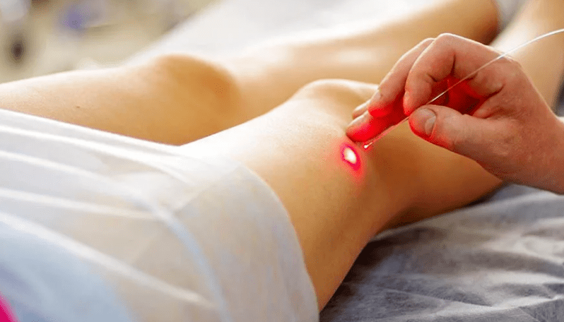 Freezing of varicose veins
