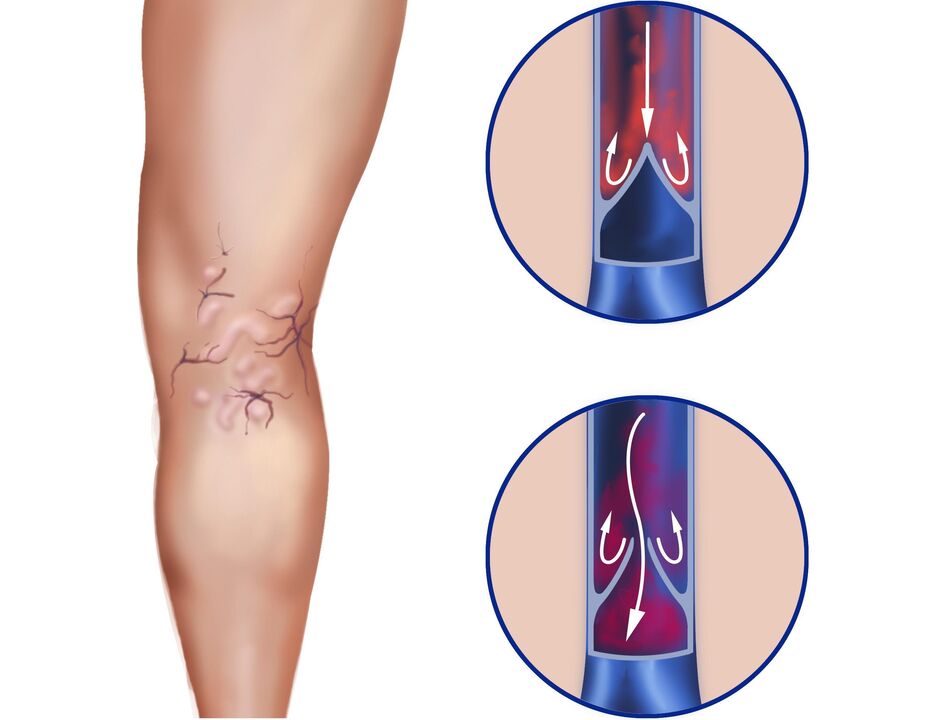What happens on veins for varicose veins