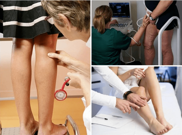Varicose veins on the feet