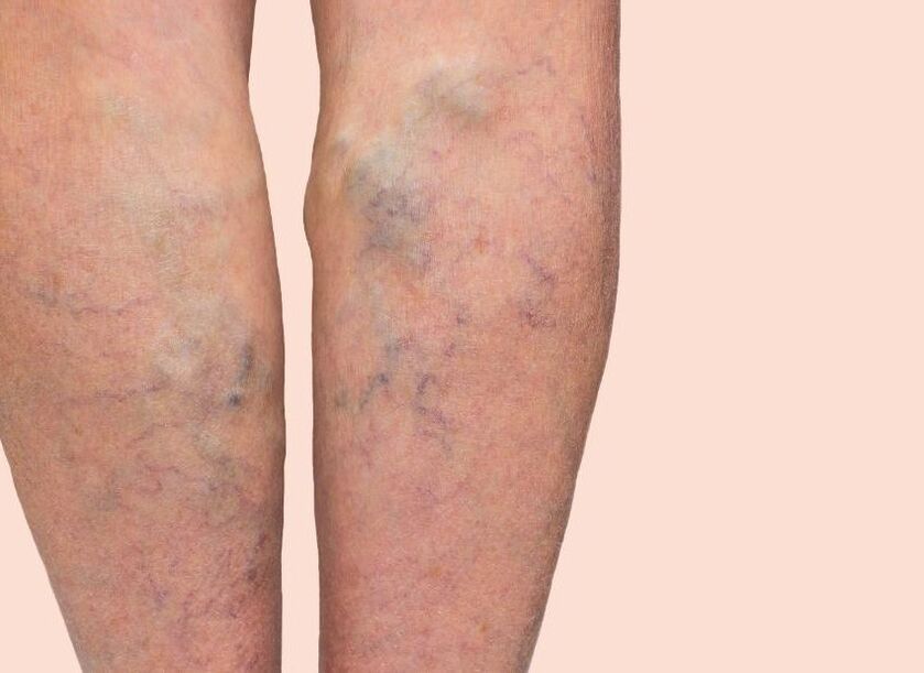 What varicose veins are like
