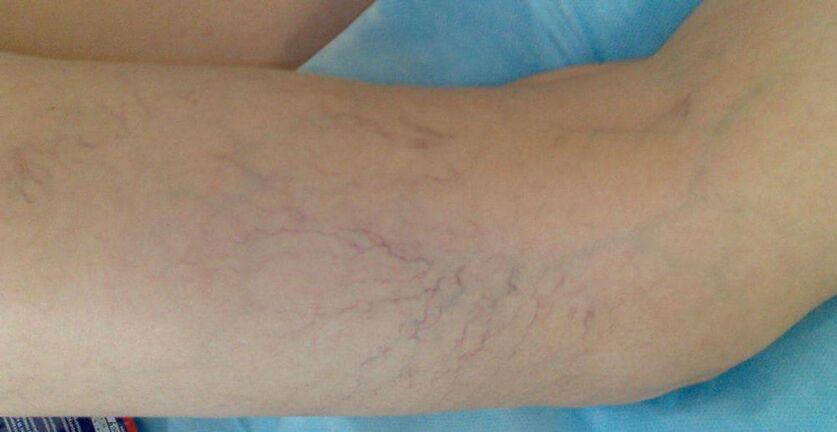 A vascular star in the foot