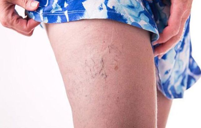 Varicose veins in the feet