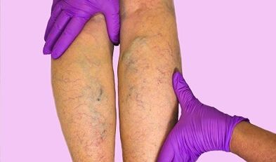 What can and cannot be done with varicose veins