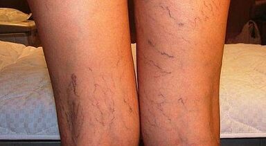 How to Treat Varicone Development in Women in Women