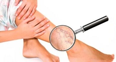 The cause of varicose veins