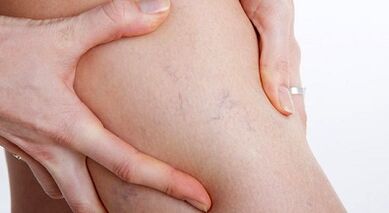 The signs and symptoms of varicose veins