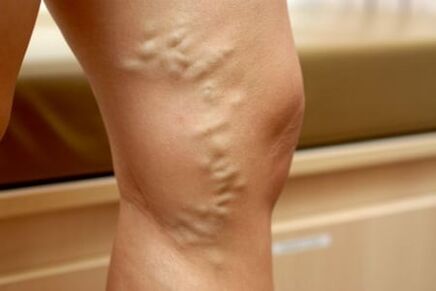 Drugs for varicose veins
