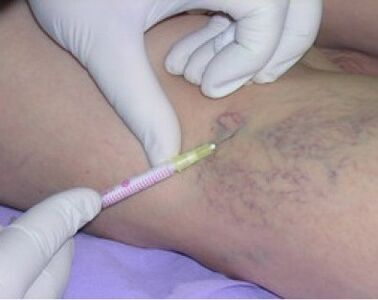 Injection for varicose veins