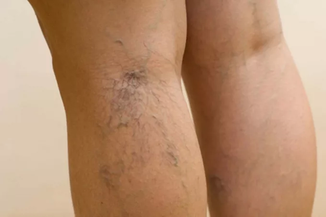 Leg vein pathology