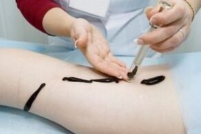the use of leeches for the treatment of varicose veins