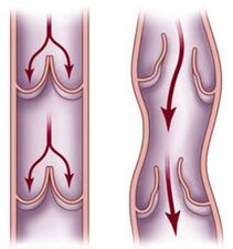 Healthy veins and blood flow are affected in varicose veins