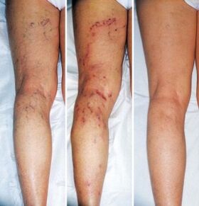 The results of varicose vein treatment on the lower leg