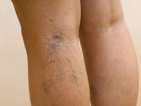 Veins protruding from under the skin are symptoms of varicose veins in the legs