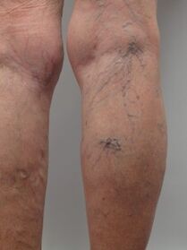 With varicose veins on the lower leg, tortuous veins protrude above the surface of the skin