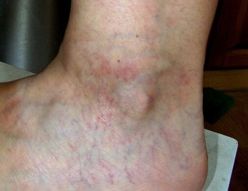 Manifestation of varicose veins on the lower leg